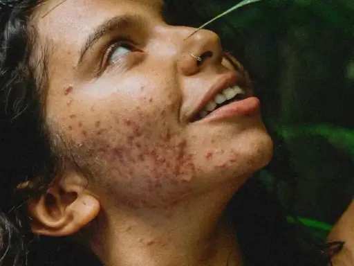Visage d'une jeune femme aux cheveux sombres, le regard levé, présentant une acné inflammatoire marquée sur la joue et le cou. Une feuille verte effleure son front.