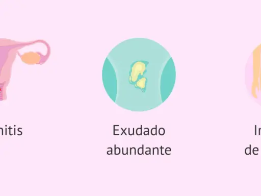 Ilustración de vaginitis, exudado y picazón vaginal, síntomas comunes de tricomoniasis.