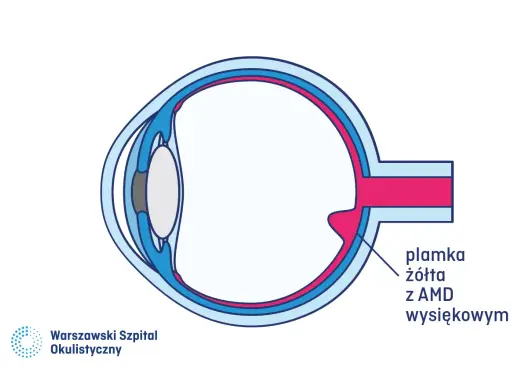 Schemat oka z zaznaczoną plamką żółtą z AMD wysiękowym.