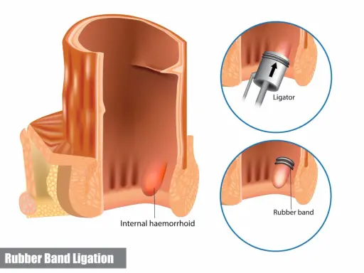 Illustration visar hur man kan ta bort hemorrojder med en gummibandsligering. Ett instrument placerar ett band runt hemorrojden.