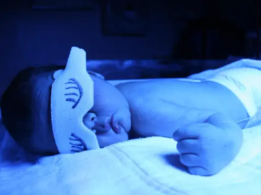 Neonato sotto lampada blu per curare l'ittero, con mascherina protettiva sugli occhi.
