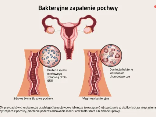 Ilustracja porównuje zdrową pochwę z dominującymi bakteriami kwasu mlekowego do waginozy bakteryjnej, gdzie przeważają bakterie chorobotwórcze.