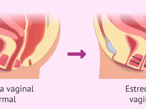 Ilustración comparativa de la abertura vaginal normal y la estrechez vaginal, donde se aprecian espasmos musculares en la segunda.