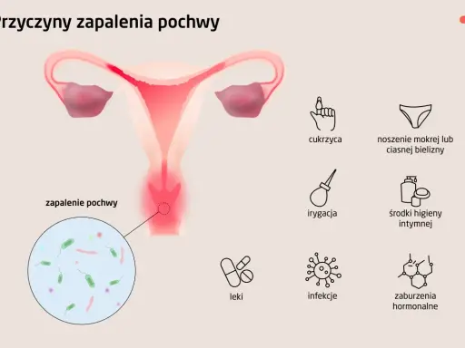 Ilustracja przedstawia przyczyny zapalenia pochwy: cukrzyca, mokra bielizna, irygacja, środki higieny intymnej, leki, infekcje, zaburzenia hormonalne.