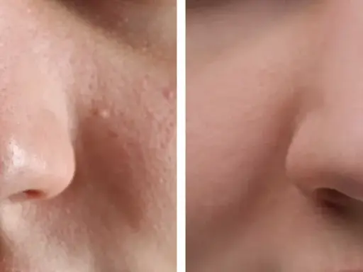 Avant/après : peau du nez avec points noirs avant et après extraction, montrant une peau plus lisse et nette.
