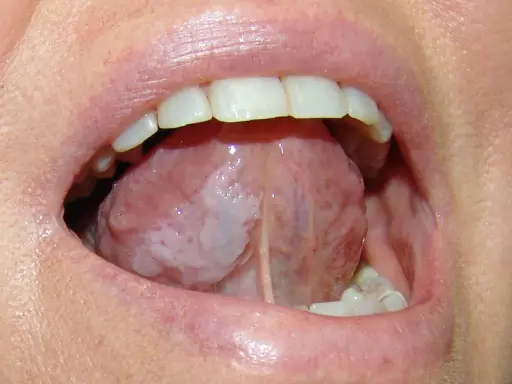 Lingua con aree biancastre, possibile leucoplachia, che potrebbe indicare un tumore alla lingua.