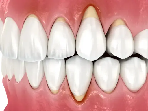 Zbliżenie na zęby i dziąsła, ukazujące odsłonięte korzenie zębów, co może być przyczyną tzw. gummy smile.
