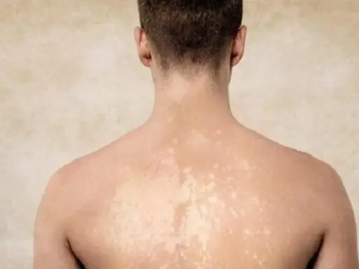 Dos de homme montrant des taches blanches sur la peau, possiblement dues à une exposition au soleil.