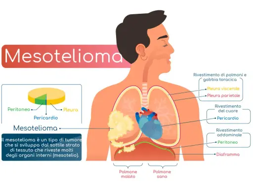 Il mesotelioma è un tumore che colpisce il mesotelio, il sottile strato che riveste gli organi interni. L'immagine mostra dove può svilupparsi.