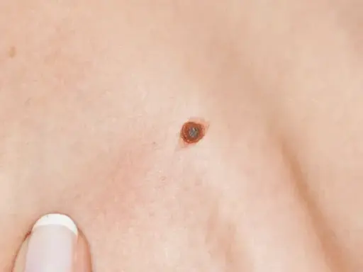 Gros plan sur une peau humaine, montrant une texture légèrement granuleuse, un grain de beauté brun et le bord des lèvres.