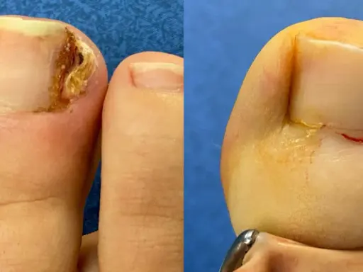 Avant/après chirurgie d'un ongle incarné douloureux par un podologue. Le pied gauche montre l'ongle abîmé, le droit, après intervention, suturé.