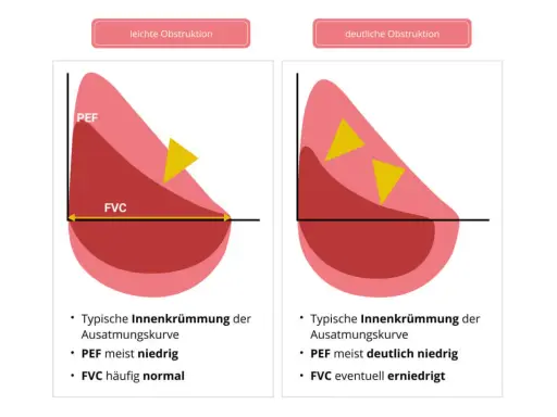 Diagramm zeigt Lungenfunktion bei Asthma. Links leichte Obstruktion mit PEF meist niedrig, rechts deutliche Obstruktion mit PEF deutlich niedrig.