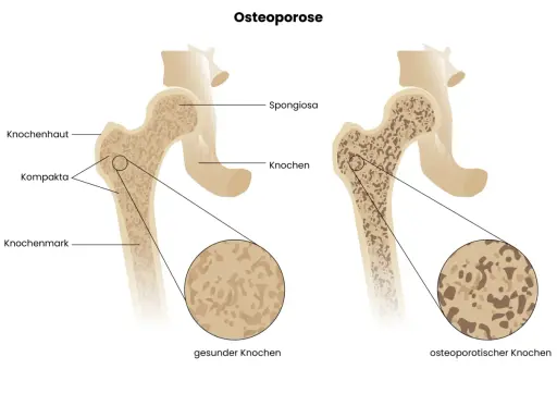 Vergleich gesunder und osteoporotischer Knochen. Rauchen kann Osteoporose fördern, indem es die Knochendichte verringert.