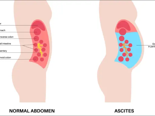 Ilustracja porównująca prawidłowy brzuch z brzuchem z wodobrzuszem (ascites), pokazująca nagromadzenie płynu.