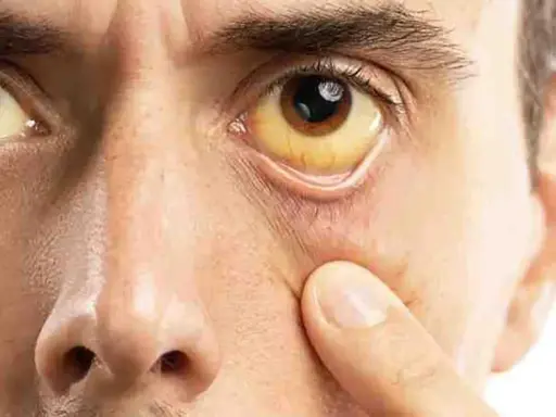 Ojo con esclerótica amarilla, indicativo de ictericia, posiblemente relacionada con sd Gilbert.