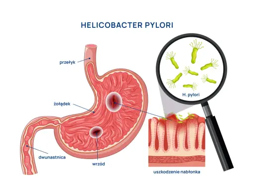 Helicobacter pylori powoduje wrzody żołądka i dwunastnicy, uszkadzając nabłonek. Objawy jelitowe mogą być związane z tym stanem.