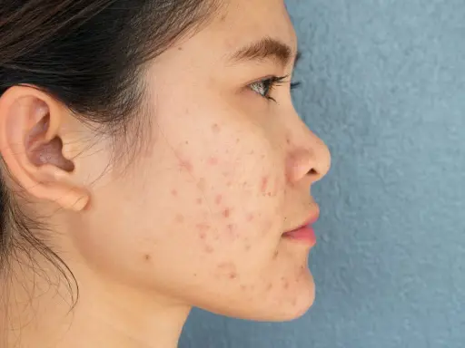 Profil d'une jeune femme avec des marques d'acné sur le visage. Des conseils sur comment enlever les cicatrices d'acné peuvent aider à retrouver une peau nette.