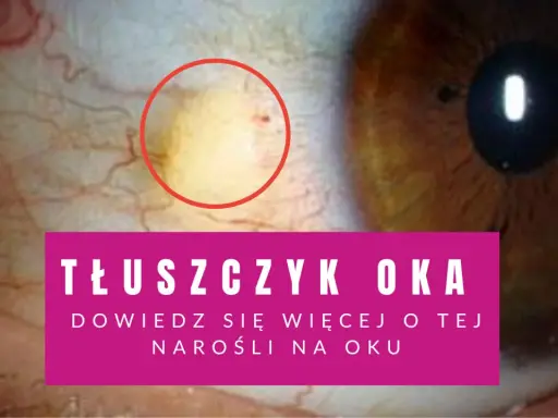 Widoczna biała plamka na białku oka, otoczona czerwonym okręgiem, to tłuszczyk. Dowiedz się więcej o tej narośli.