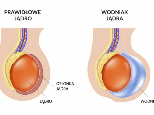 Porównanie prawidłowego jądra z wodniakiem jądra, który może pojawić się po operacji przepukliny pachwinowej.
