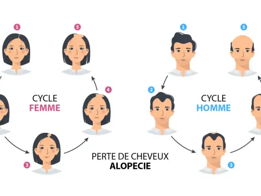 Illustration du cycle de la perte de cheveux, montrant l'alopécie chez la femme et l'homme.