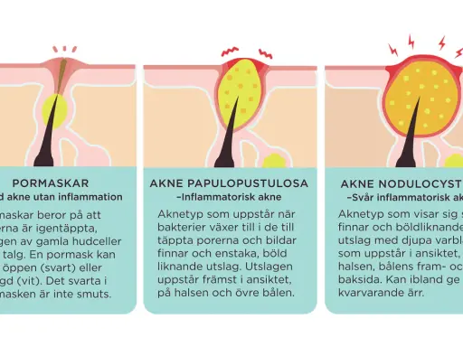 Illustrationer visar hur man vet om man har akne: pormaskar, inflammatorisk akne och svår inflammatorisk akne.