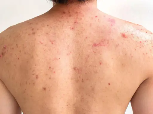 Le dos d'une personne présente de nombreuses imperfections rouges et enflammées, typiques de l'acné du dos.