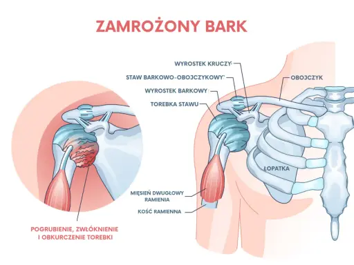 Anatomia barku z zaznaczonym mięśniem dwugłowym ramienia i pogrubioną torebką stawu, ilustracja problemu "zamrożonego barku".