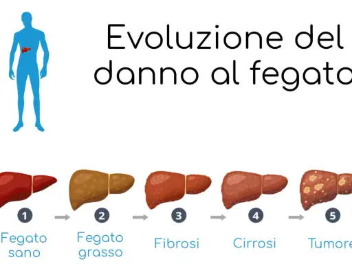 Evoluzione del danno epatico: da fegato sano a fegato grasso, poi fibrosi, cirrosi e infine tumore.