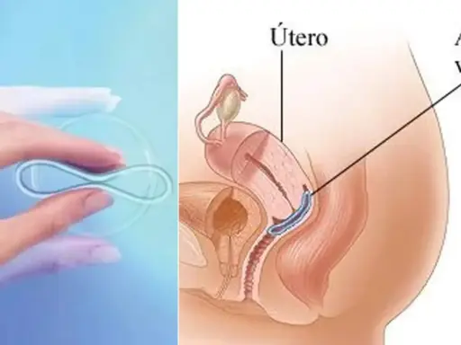 Anillo vaginal anticonceptivo en mano y su ubicación en el útero. No se debe quitar el anillo anticonceptivo durante relaciones.