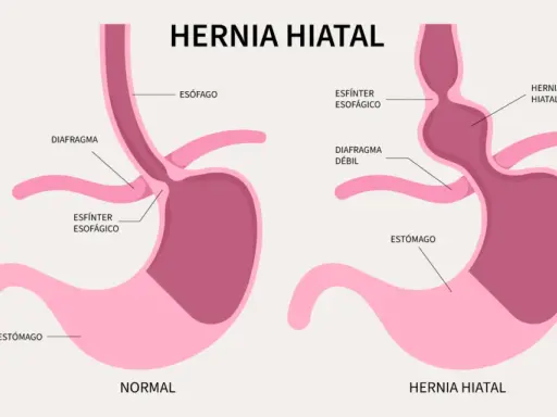 Hernia de hiato: Identifica sus síntomas y cuándo buscar ayuda.