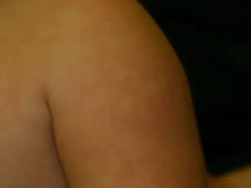 Éruption cutanée sur le bras, possiblement du pityriasis alba. Le traitement est souvent simple et vise à hydrater la peau.