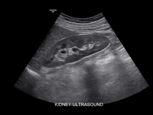 Obraz USG nerki. Czy usg jamy brzusznej wykryje raka? Badanie pokazuje strukturę nerki, pomagając w diagnostyce.