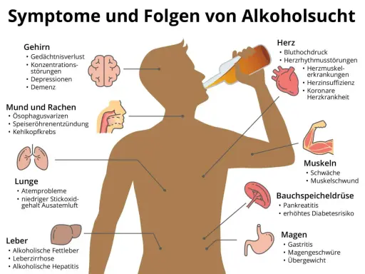 Illustration zeigt Symptome von Alkoholsucht: Gehirn, Herz, Lunge, Leber, Magen, Bauchspeicheldrüse, Muskeln, Mund & Rachen. Die 10 Stufen des Alkoholismus sind hier nicht dargestellt.