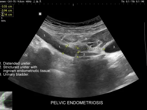USG miednicy: poszerzony i zwężony moczowód z tkanką endometrialną, pęcherz moczowy.