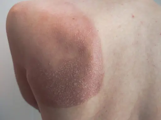 Une petite cloque d'eau sur la peau, signe d'un coup de soleil. La zone affectée est rouge et légèrement écailleuse.