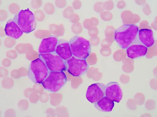 Cellule immature viola, indicative di leucemia linfoblastica acuta, circondate da globuli rossi.