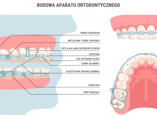 Aparat ortodontyczny a wypadanie zębów: Prawda czy mit?