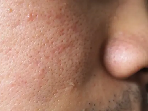 Gros plan sur la peau d'un visage, montrant des pores dilatés et une petite verrue sur la joue.