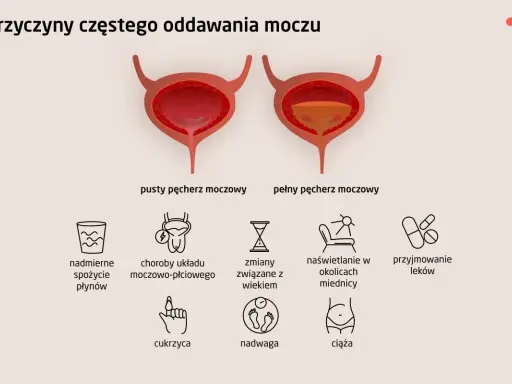 Ilustracja pokazuje pusty i pełny pęcherz moczowy, wyjaśniając przyczyny częstego oddawania moczu, w tym uczucie pełnego pęcherza.