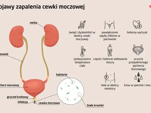 Objawy zapalenia cewki moczowej (ICD-10): pieczenie, ból, gorączka, krew w moczu, powiększone węzły chłonne.