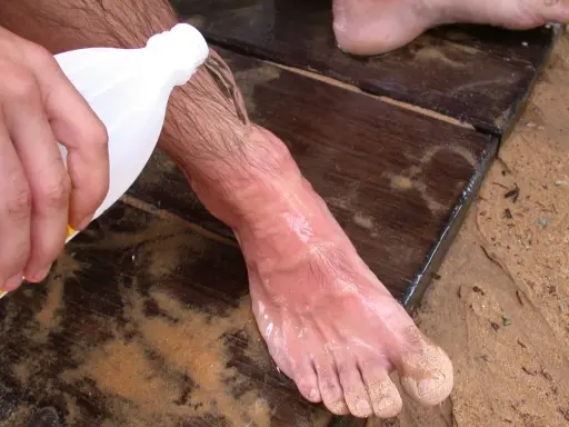 Piede bagnato sulla sabbia, con liquido versato da una bottiglia. Forse un rimedio dopo un incontro con una medusa Chrysaora hysoscella.