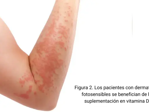 Brazo con erupción cutánea roja y escamosa.