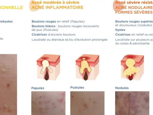 Schéma illustrant les différents types d'acné, des points blancs aux kystes, montrant l'évolution d'un bouton de puberté.