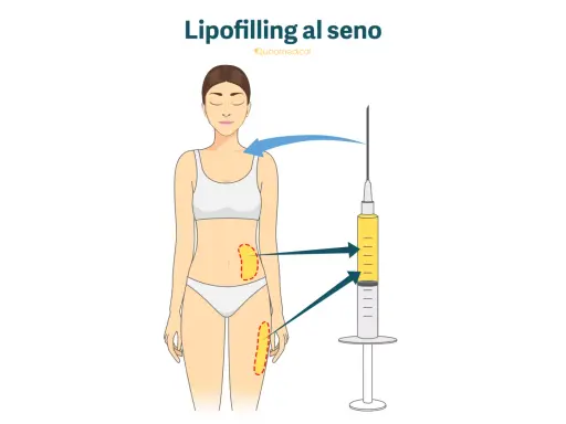 Illustrazione del lipofilling al seno: grasso prelevato da addome e cosce viene iniettato per aumentare il volume del seno.
