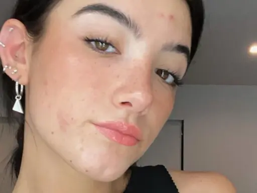 Gros plan sur le visage d'une jeune femme aux yeux marron, avec un bouton sur le front et des boucles d'oreilles.