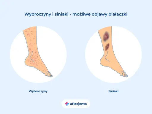 Wybroczyny i siniaki na nogach mogą być objawami białaczki szpikowej. Ilustracja pokazuje zmiany skórne.