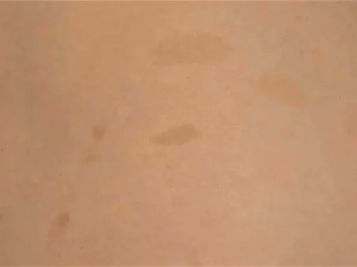 Macchie caffè latte sulla pelle, possibili indicatori di neurofibromatosi.