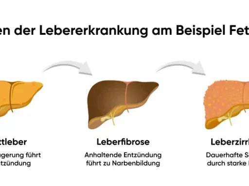 Illustration zeigt Stadien der Lebererkrankung: gesunde Leber, Fettleber, Leberfibrose, Leberzirrhose und Leberkrebs. Was tun bei Fettleber? Frühzeitige Behandlung ist wichtig.