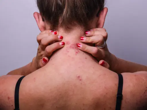 Vue arrière d'une personne se grattant le cou et le haut du dos, montrant des rougeurs et des irritations dues à l'eczéma.