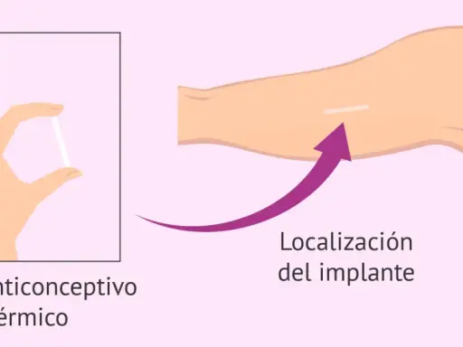 Mano sostiene implante anticonceptivo subdérmico. Flecha indica localización del implante en el brazo.